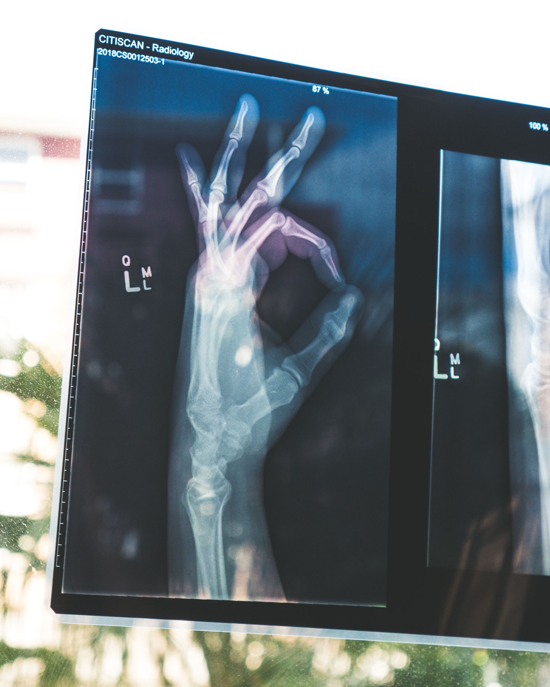 hand x ray
